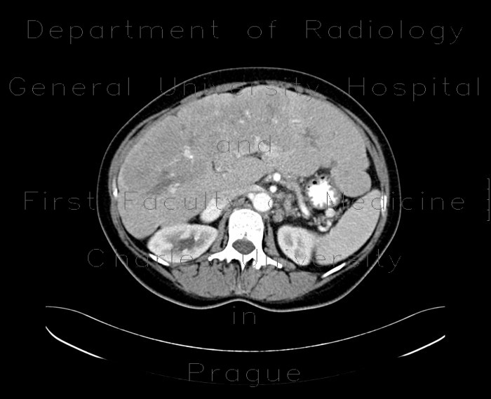 Radiology image - Liver metastases, carcinoid: Abdomen, Liver: CT - Computed tomography