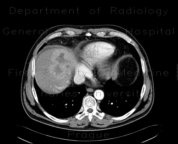 Radiology image - Liver metastases of carcinoid, embolization: Abdomen, Liver: CT - Computed tomography