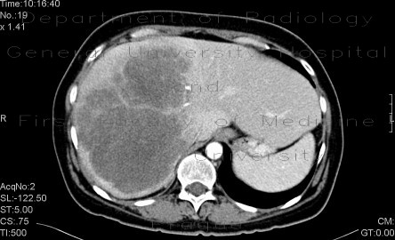 Radiology image - Liver metastasis, huge: Abdomen, Liver: CT - Computed tomography