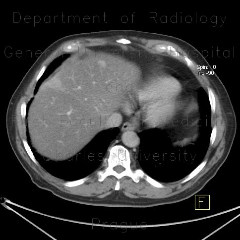 Radiology image - Liver metastasis of adenocarcinoma of colon, colorectal carcinoma, biopsy: Abdomen, Liver: CT - Computed tomography