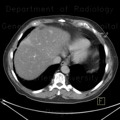 Liver metastasis of adenocarcinoma of colon, colorectal carcinoma, biopsy