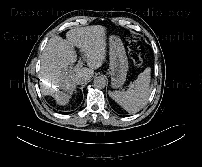 Radiology image - Liver metastasis of colorectal cancer, RFA: Abdomen, Liver: CT - Computed tomography