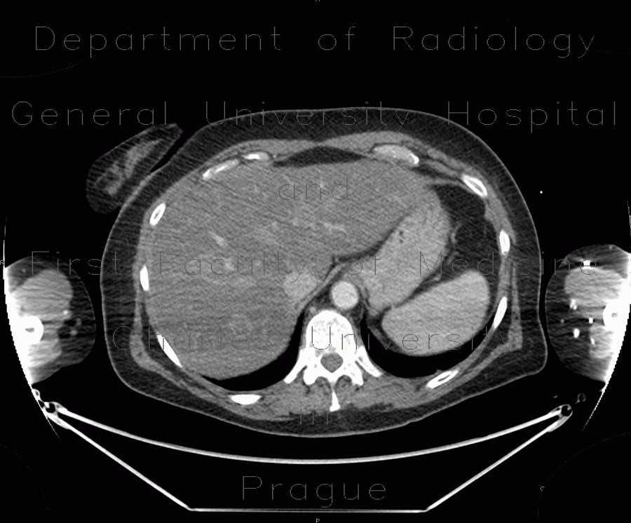 Radiology image - Liver metastasis, steatosis of liver, fatty liver, hepatopathy, correlation: Abdomen, Liver: CT - Computed tomography