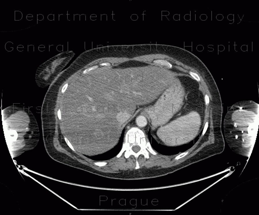 Liver metastasis, steatosis of liver, fatty liver, hepatopathy, correlation