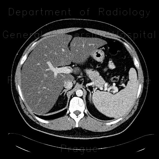 Radiology image - Liver steatosis: Abdomen, Liver: CT - Computed tomography