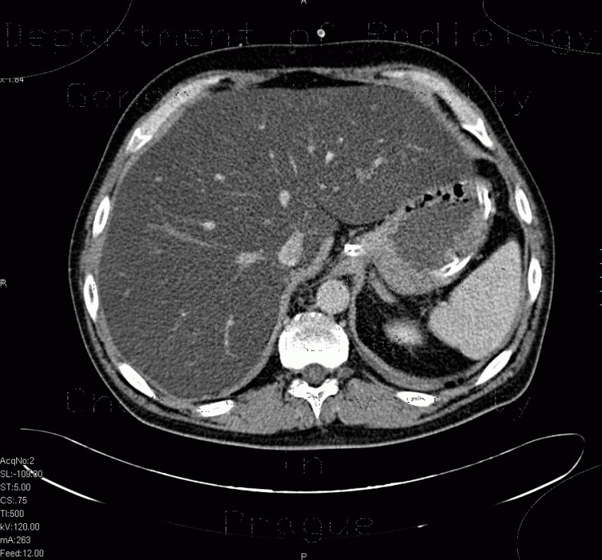 Liver steatosis