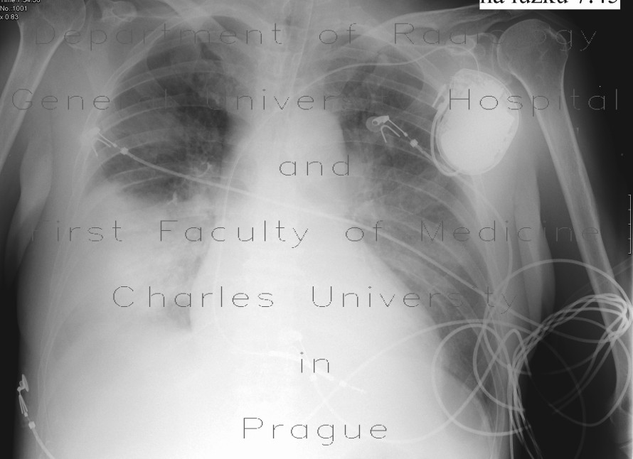 Radiology image - Lobar pneumonia: Thorax, Lung: X-ray - Plain radiograph