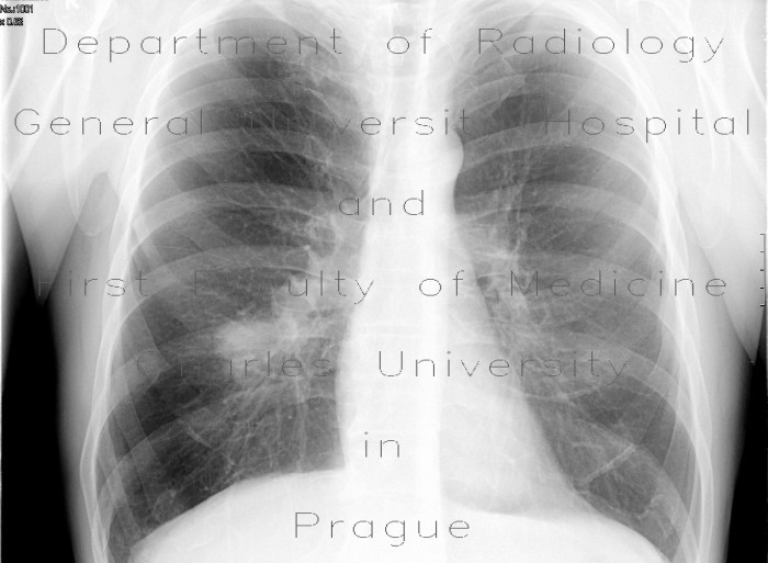 Lobectomy, expaned lung, errect radiograph