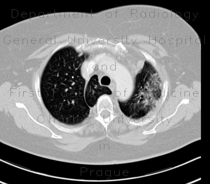 Radiology image - Lobus venae azygos, azygous lobe: Thorax, Lung, Mediastinum and pleural cavity: CT - Computed tomography