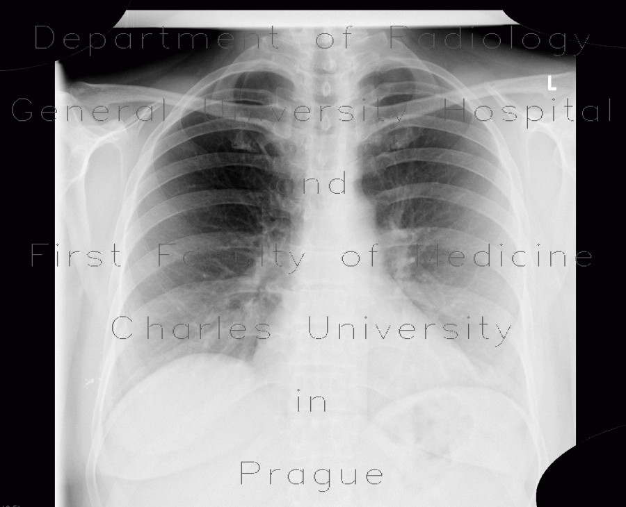 Radiology image - Lobus venae azygos, azygous vein lobe: Thorax, Lung: X-ray - Plain radiograph
