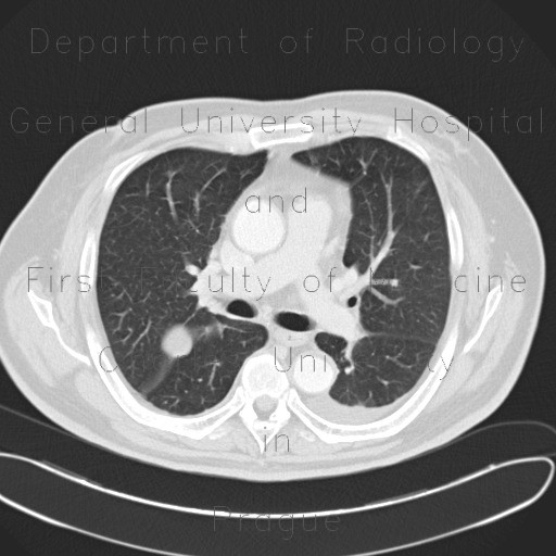 Loculated effusion