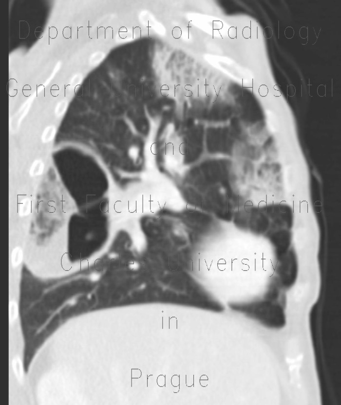 Radiology image - Lung abscess: Thorax, Lung: CT - Computed tomography
