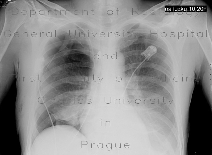 Lung bilobectomy, residual cavity, remaining lobe not expanded