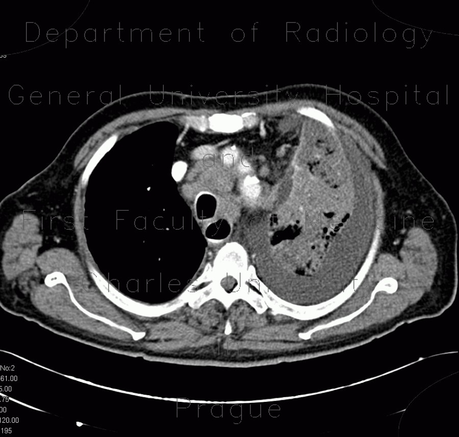 Lung cancer, infiltration of lung wing, metastasis in neuroforamina