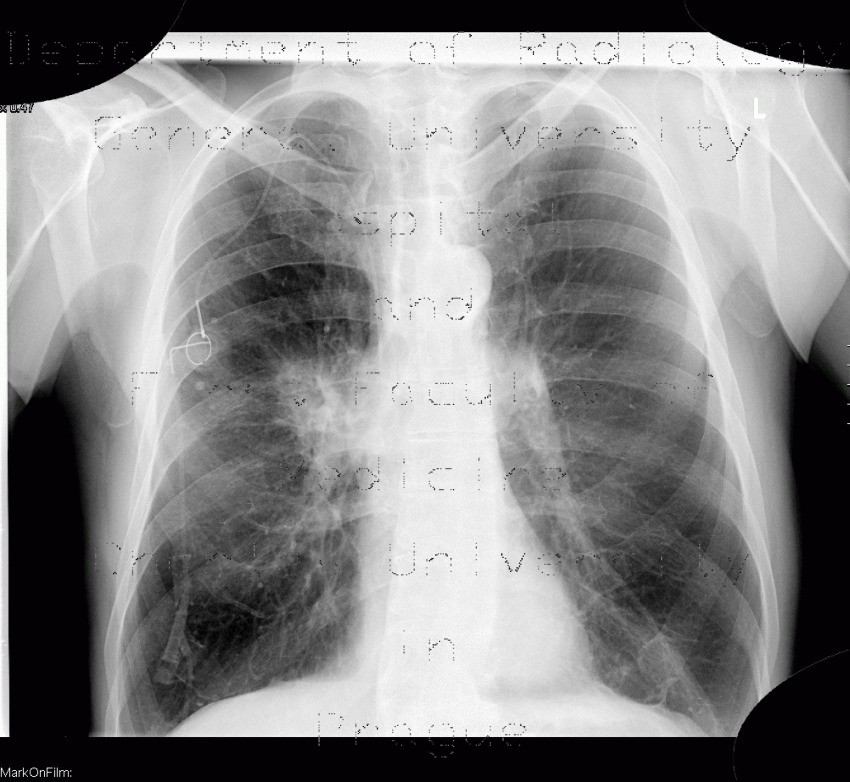 Radiology image - Lung carcinoma, biopsy: Thorax, Lung: X-ray - Plain radiograph