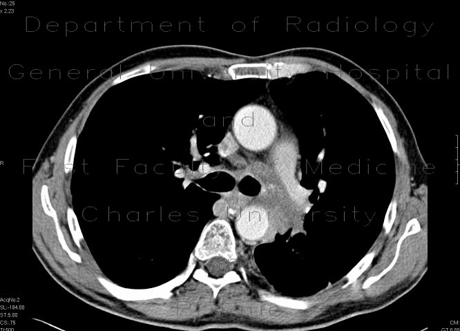 Lung carcinoma, pulmomediastinal form