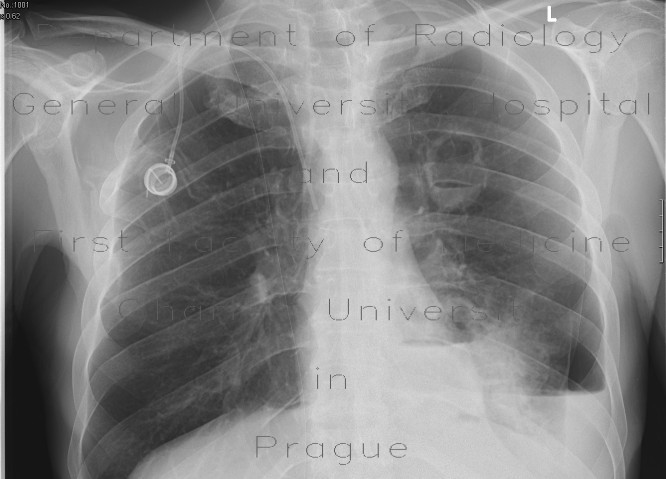 Radiology image - Lung cavity, pneumothorax, hydropneumothorax: Thorax, Lung, Mediastinum and pleural cavity: X-ray - Plain radiograph