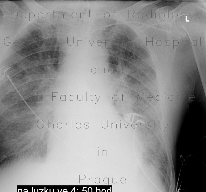 Lung congestion
