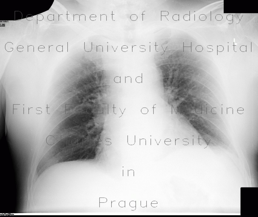 Radiology image - Lung congestion, first degree: Thorax, Lung: X-ray - Plain radiograph