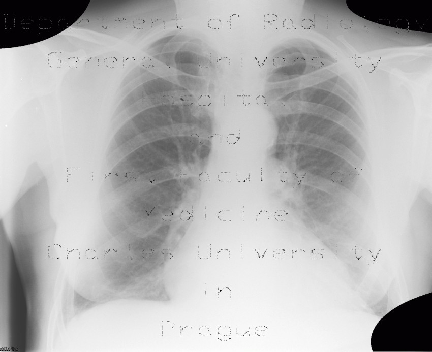 Lung congestion, first degree