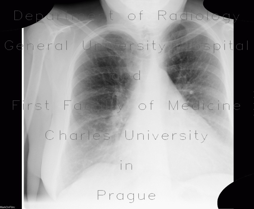 Lung congestion, first degree