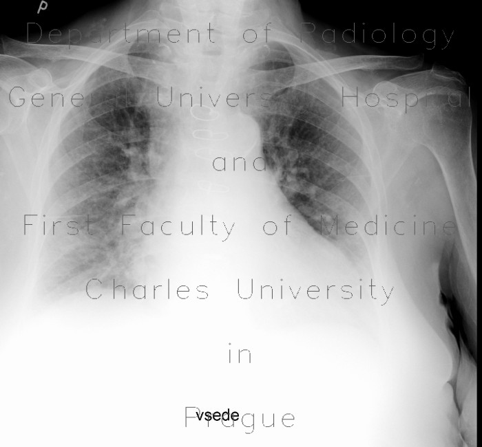 Lung congestion, mild