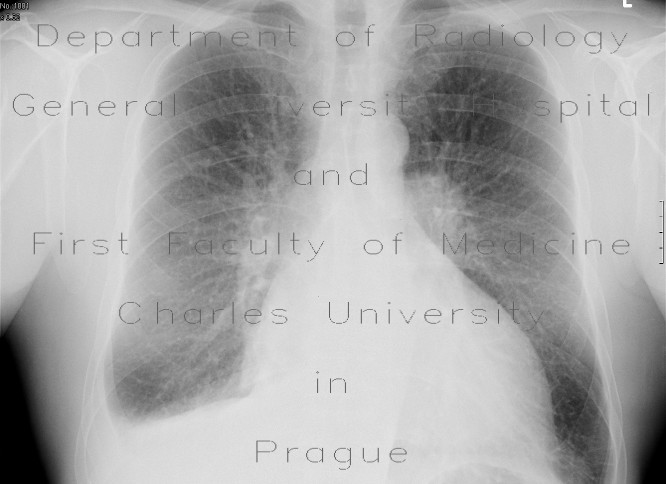 Lung congestion, pleural effusion