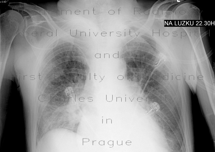 Lung congestion, supine chest radiograph