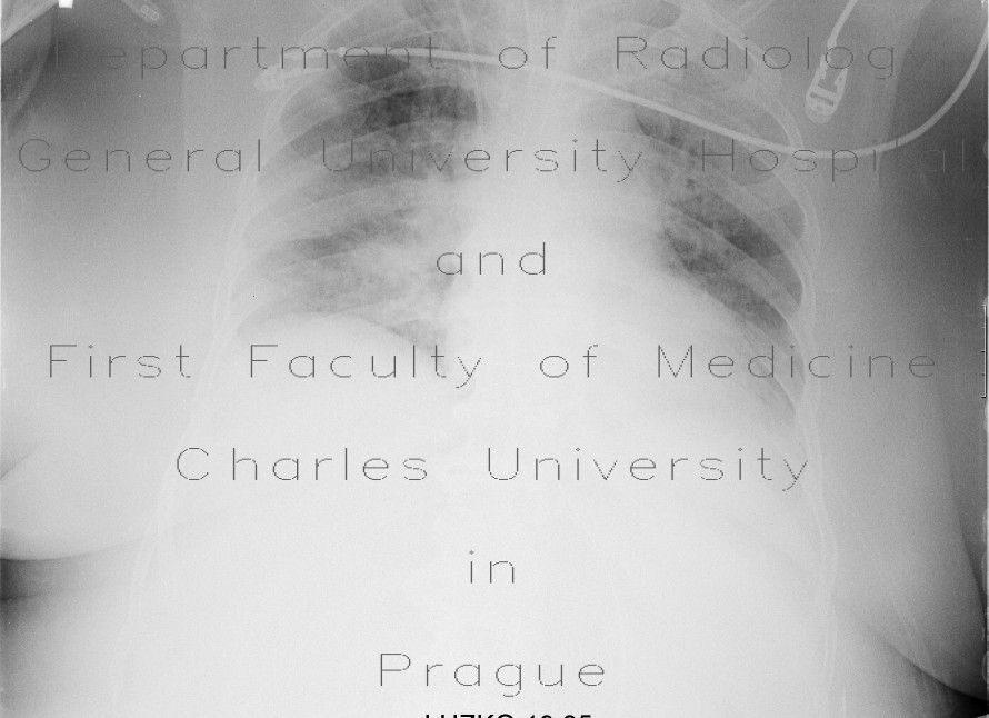 Radiology image - Lung edema, before and after therapy: Thorax, Lung, Mediastinum and pleural cavity: X-ray - Plain radiograph