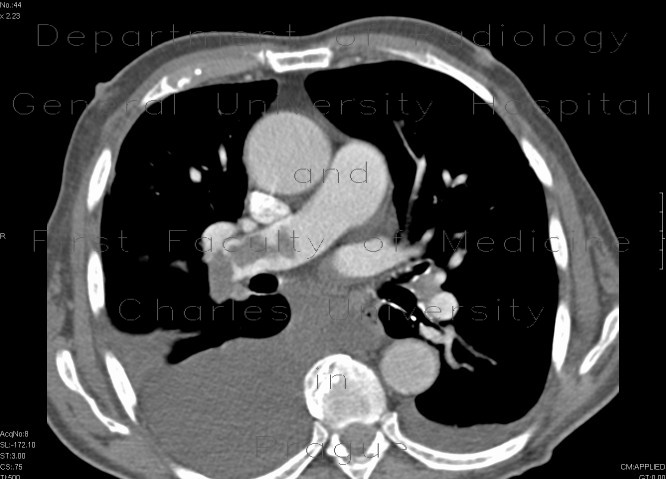 Radiology image - Lung embolism, massive: Thorax, Vessels: CT - Computed tomography