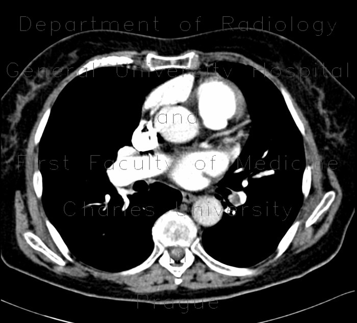 Radiology image - Lung embolism, subacute, lung infarct: Thorax, Lung, Vessels: CT - Computed tomography