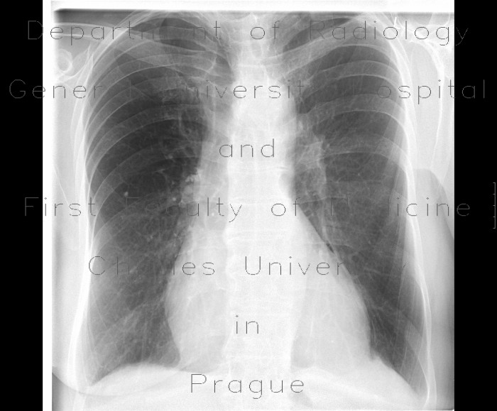 Lung emphysema