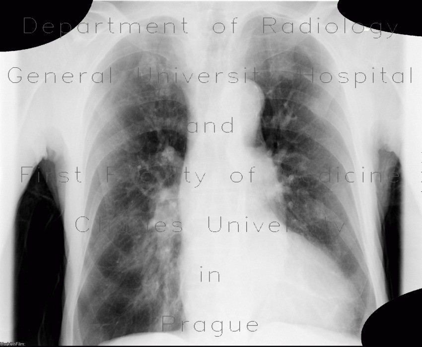 Lung emphysema