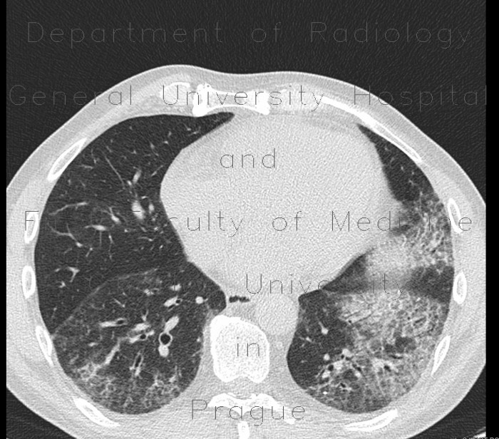 Lung fibrosis, HRCT