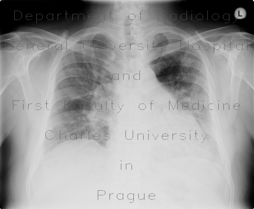 Lung fibrosis, alveolitis