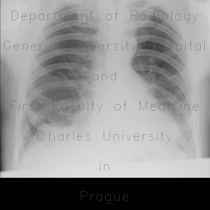 Lung fibrosis, basal