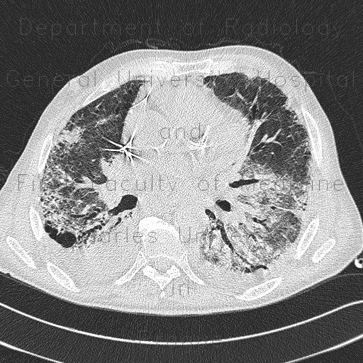 Lung fibrosis, pneumonia, pleural effusion