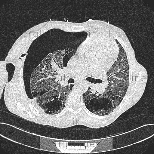 Radiology image - Lung fibrosis, pneumothorax: Thorax, Lung, Mediastinum and pleural cavity: CT - Computed tomography