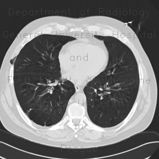 Lung hernia, centrilobular emphysema