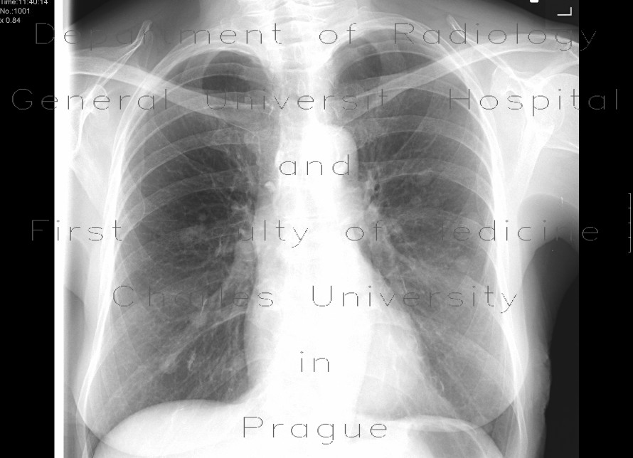 Lung metastases