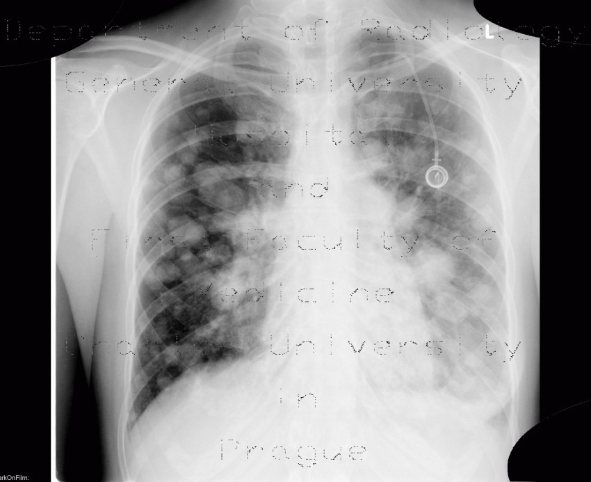 Lung metastases, canon ball