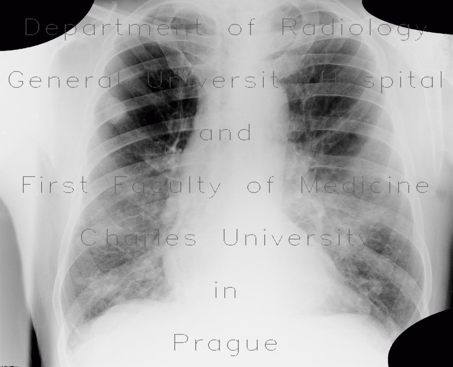 Lung metastases, cavitated metastases, bladder carcinoma