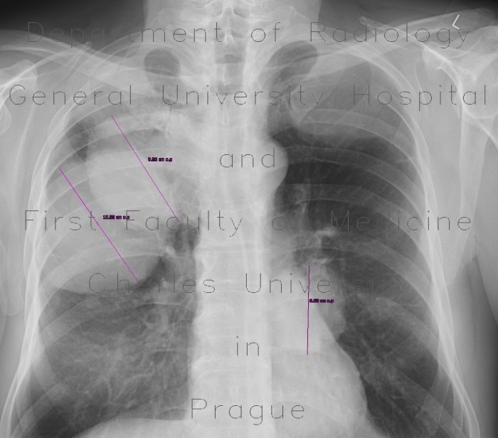 Radiology image - Lung metastases of renal cell carcinoma: Thorax, Lung: X-ray - Plain radiograph