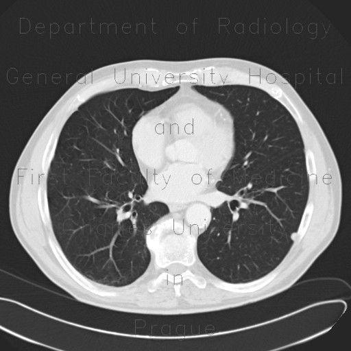 Lung nodule