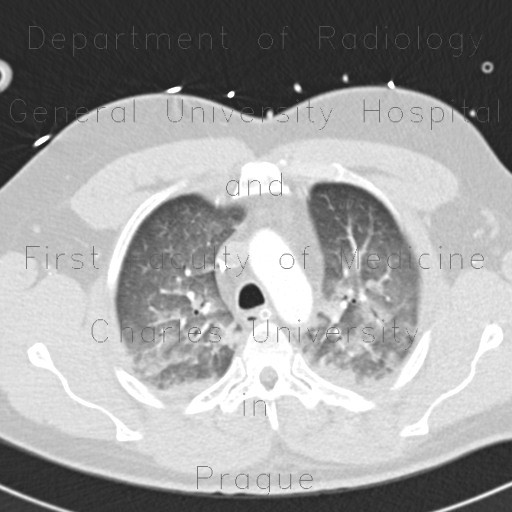 Lung oedema