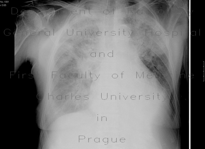 Lung oedema