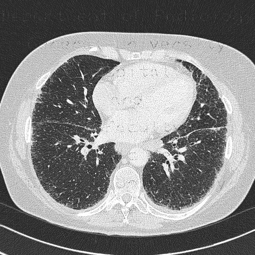 Radiology image - Lung sarcoidosis: Thorax, Lung: CT - Computed tomography