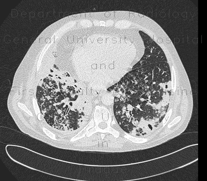 Lung tuberculosis, caseous pneumonia, HRCT