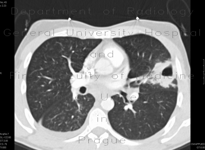 Lung tuberculosis, cavern, endobronchial spread, tree-in-bud