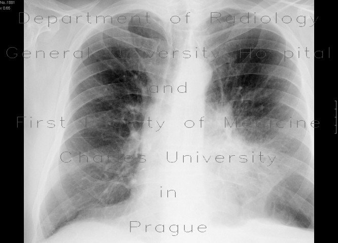Lung tumour, adjacent to the left hilum